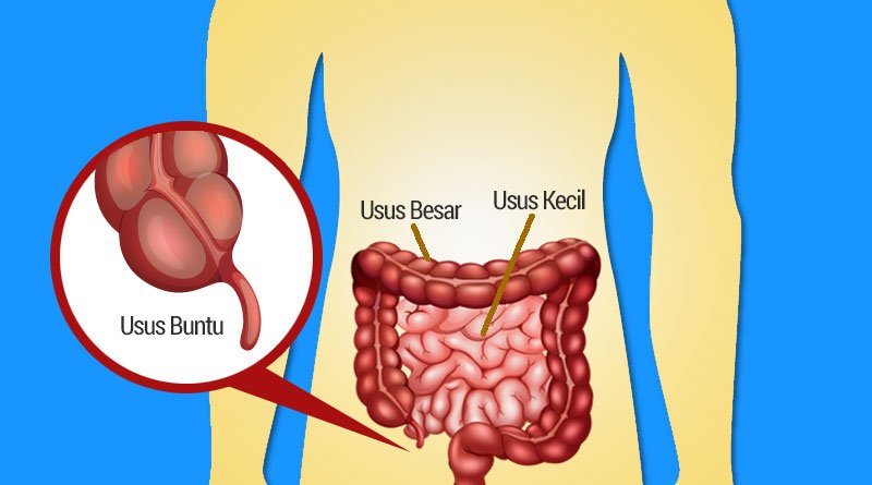 Kenali Penyakit Usus Buntu
